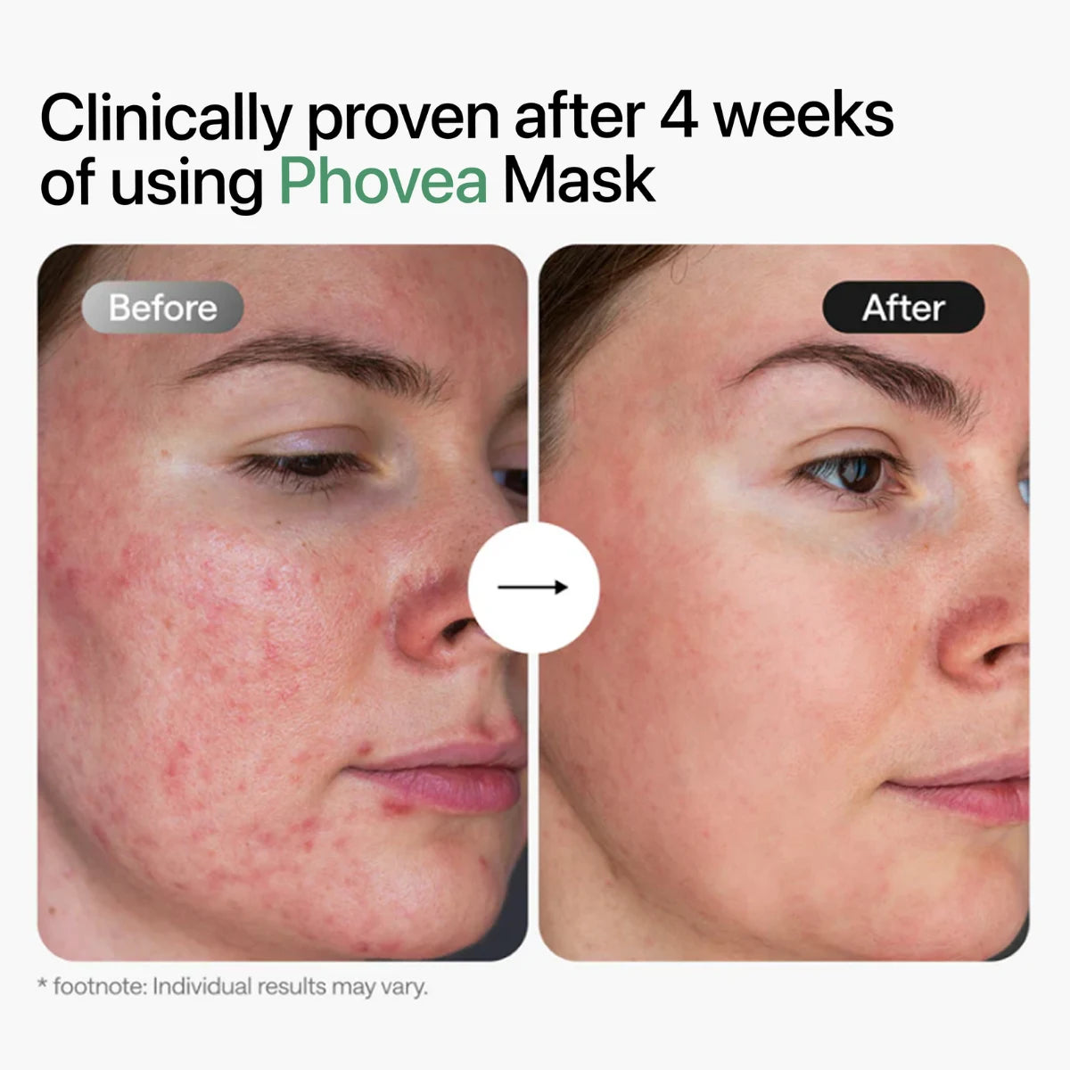 Phovea Starter Kit - LED Face Mask + Serum + Goggles + Hydrogels